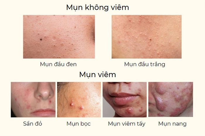 thuốc kháng sinh trị mụn