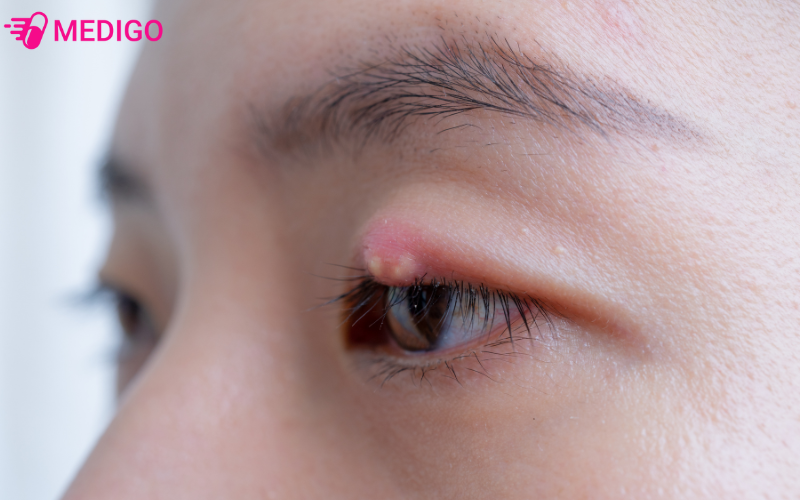 thuoc-nho-mat-rohto-antibacterial-dung-ho-tro-chua-leo-mat