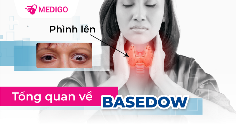 Bệnh Basedow: Nguyên nhân, triệu chứng, chẩn đoán và điều trị