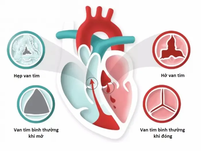 hở van tim là gì