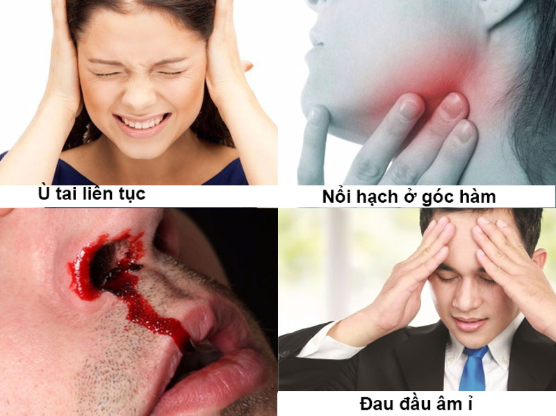 Ung thư vòm họng