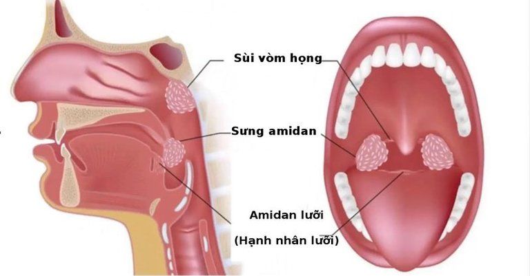 Viêm họng hạt có mủ điều trị như thế nào?