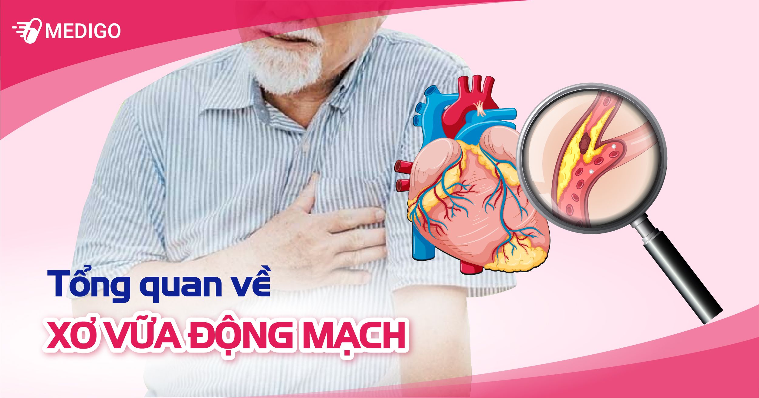 Xơ vữa động mạch: Nguyên nhân, triệu chứng và điều trị