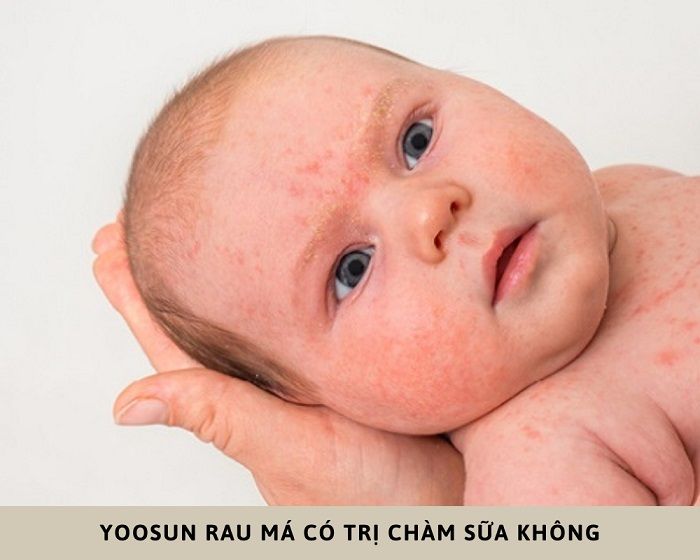 Giải đáp: Yoosun Rau Má có trị chàm sữa không?