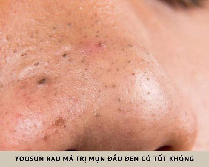 yoosun rau má có trị mụn đầu đen không